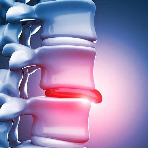 gerincfájdalom